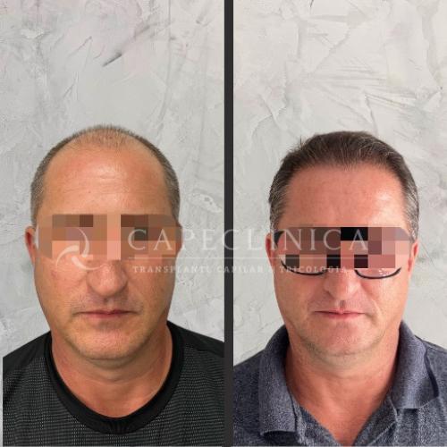 Clinica de transplantes capilar