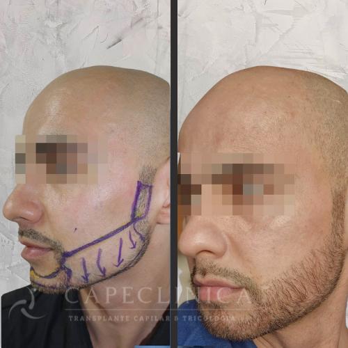 Transplante capilar masculino