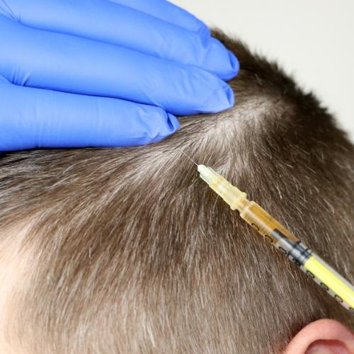 Intradermoterapia capilar preço