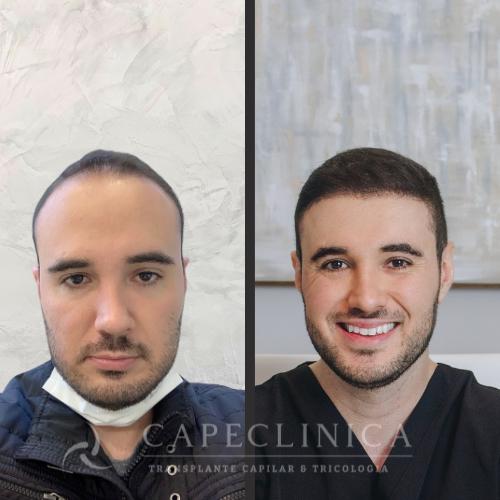 Preço do transplante capilar em Curitiba