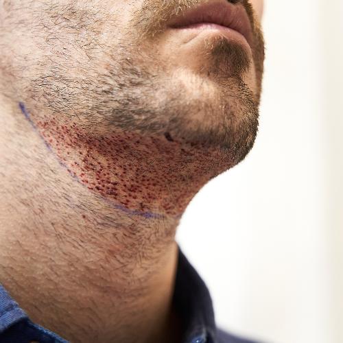 Imagem ilustrativa de Transplante de barba preço
