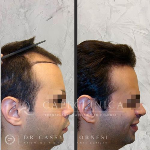 Imagem ilustrativa de Transplante capilar entradas preço