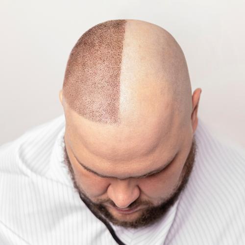 Imagem ilustrativa de Tratamento para alopecia em Curitiba